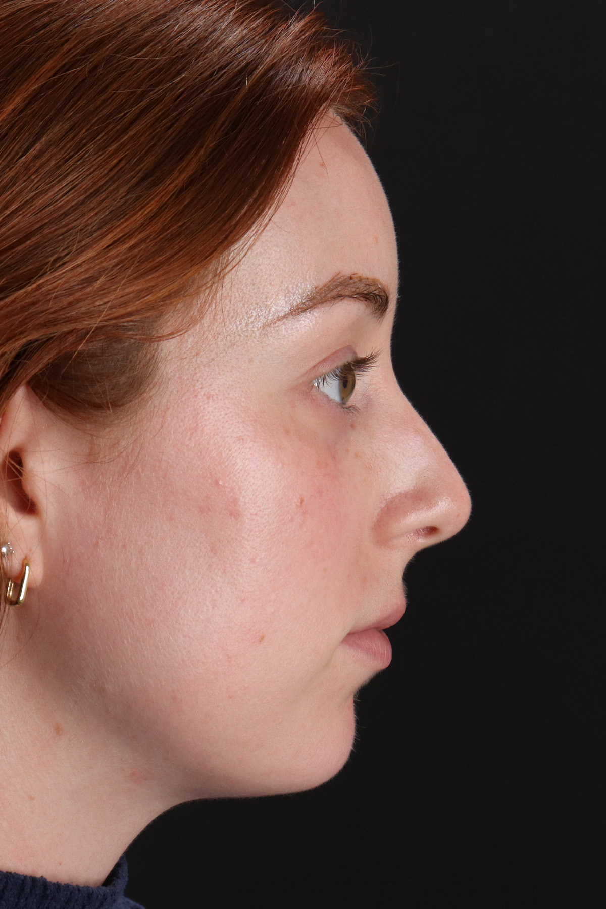 Rhinoplasty Before & After Patient #3170