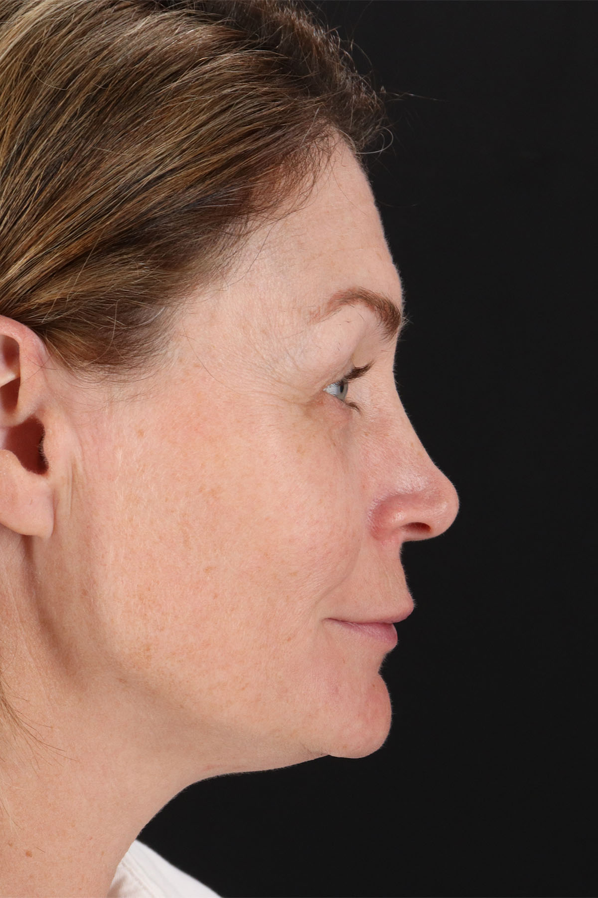 Lip Lift Before & After Patient #2144