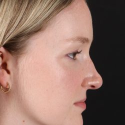 Liquid Rhinoplasty Before & After Patient #2177