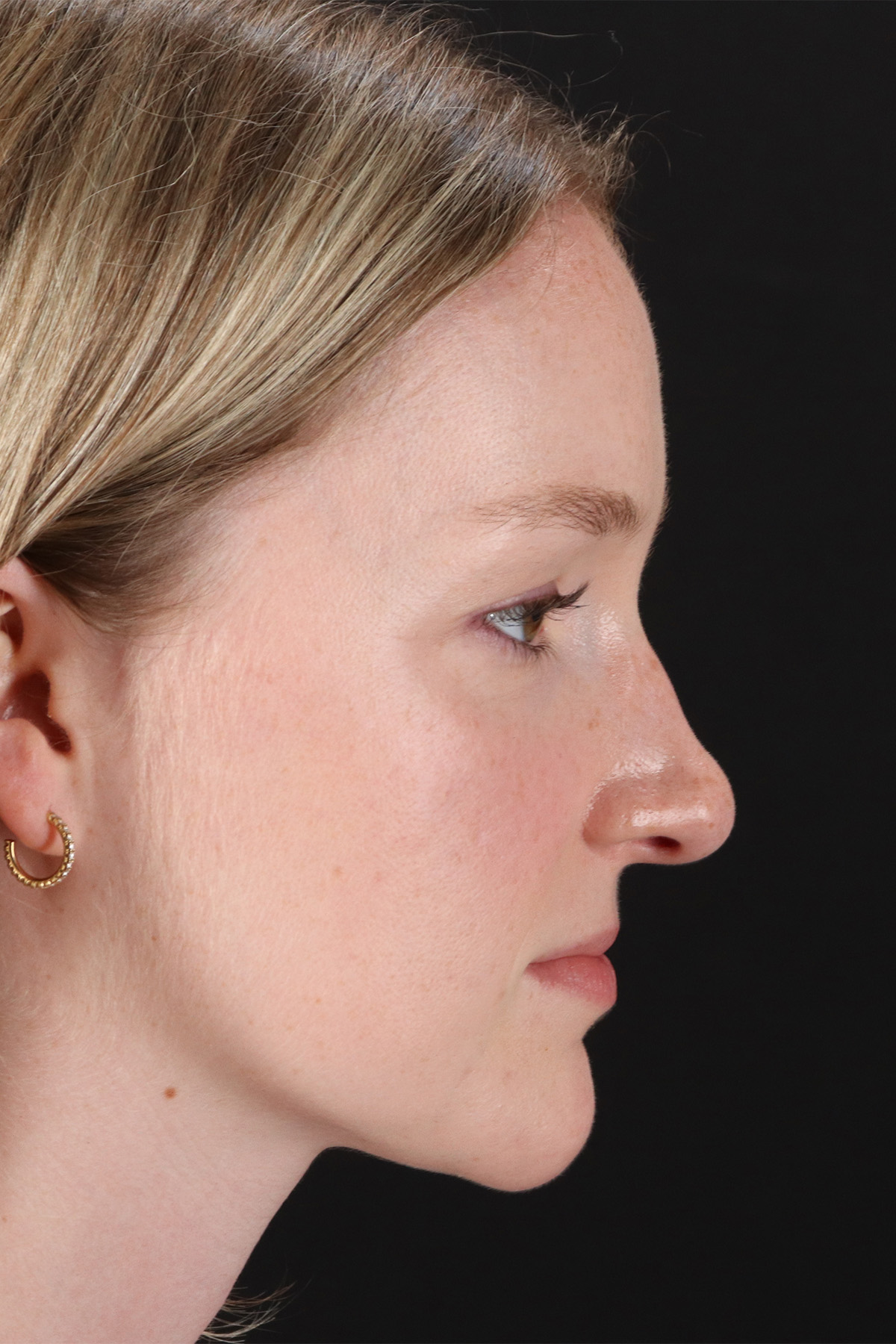 Liquid Rhinoplasty Before & After Patient #2177