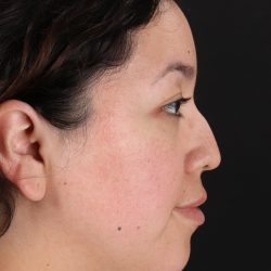 Rhinoplasty Before & After Patient #3060