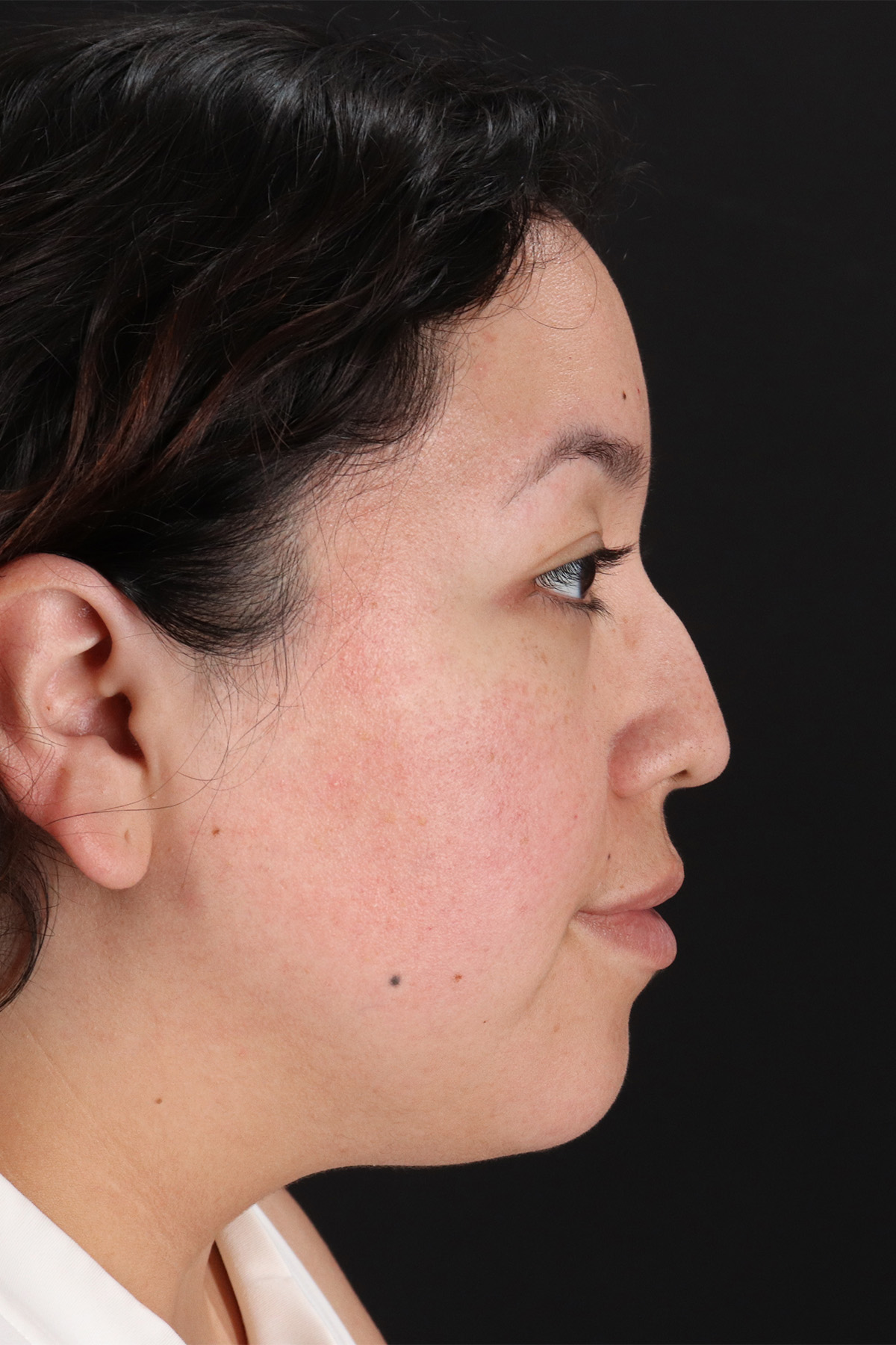 Rhinoplasty Before & After Patient #3060