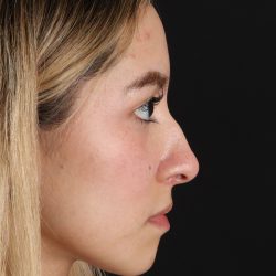 Rhinoplasty Before & After Patient #3302