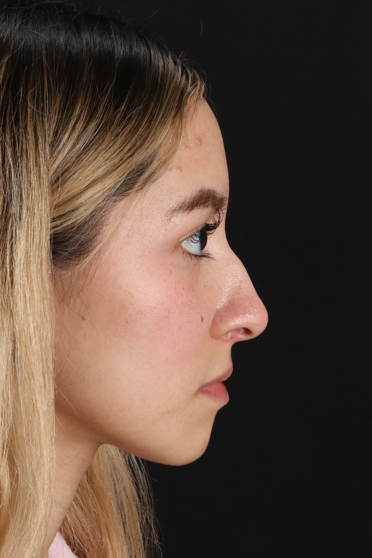 Rhinoplasty Before & After Patient #3302