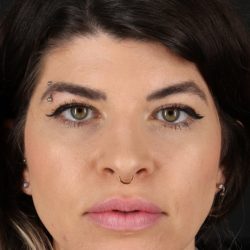Browlift Before & After Patient #1220