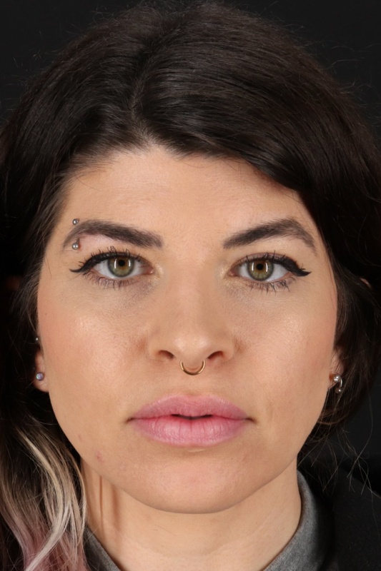 Browlift Before & After Patient #1220