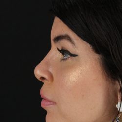 Browlift Before & After Patient #1220