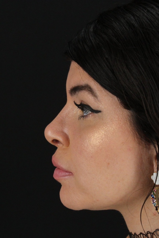 Browlift Before & After Patient #1220