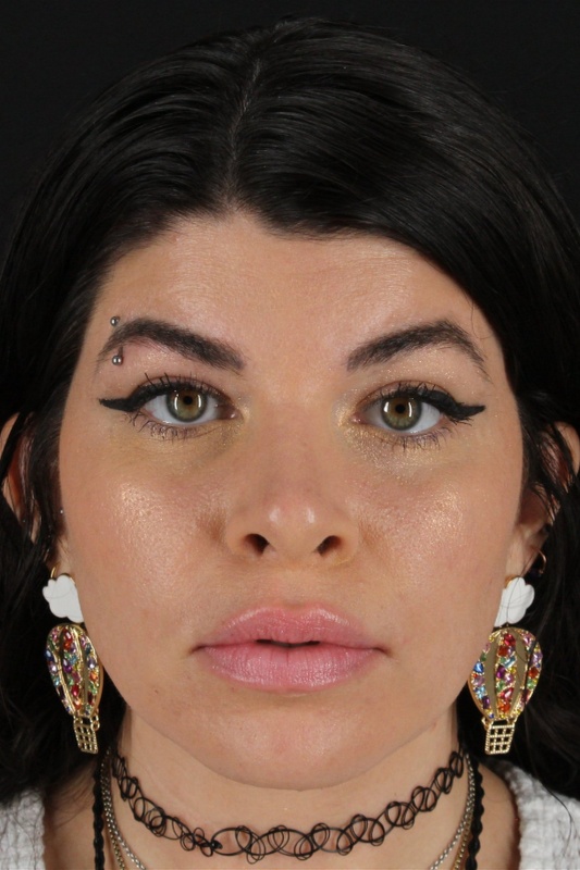 Browlift Before & After Patient #1220