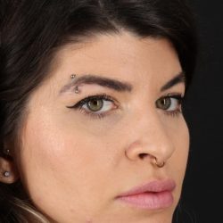 Browlift Before & After Patient #1220