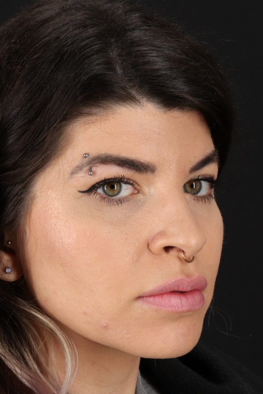 Browlift Before & After Patient #1220