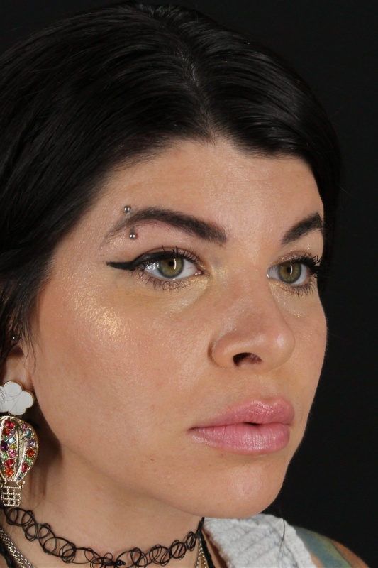 Browlift Before & After Patient #1220