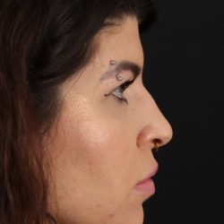 Browlift Before & After Patient #1220
