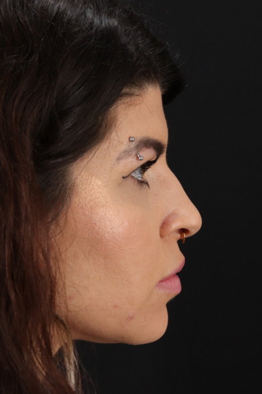 Browlift Before & After Patient #1220