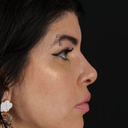 Browlift Before & After Patient #1220