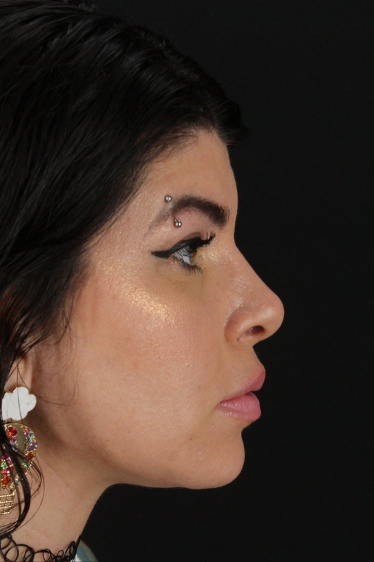 Browlift Before & After Patient #1220