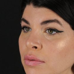 Browlift Before & After Patient #1220