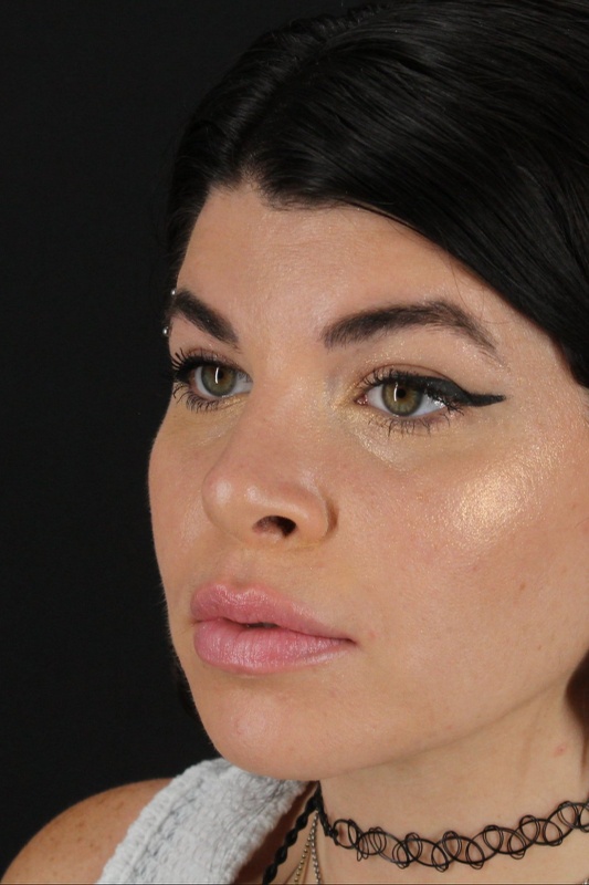 Browlift Before & After Patient #1220