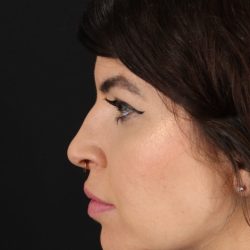 Browlift Before & After Patient #1220