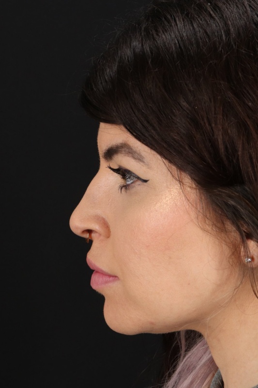 Browlift Before & After Patient #1220