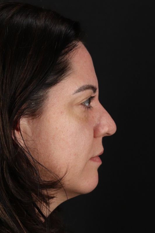 Browlift Before & After Patient #1363