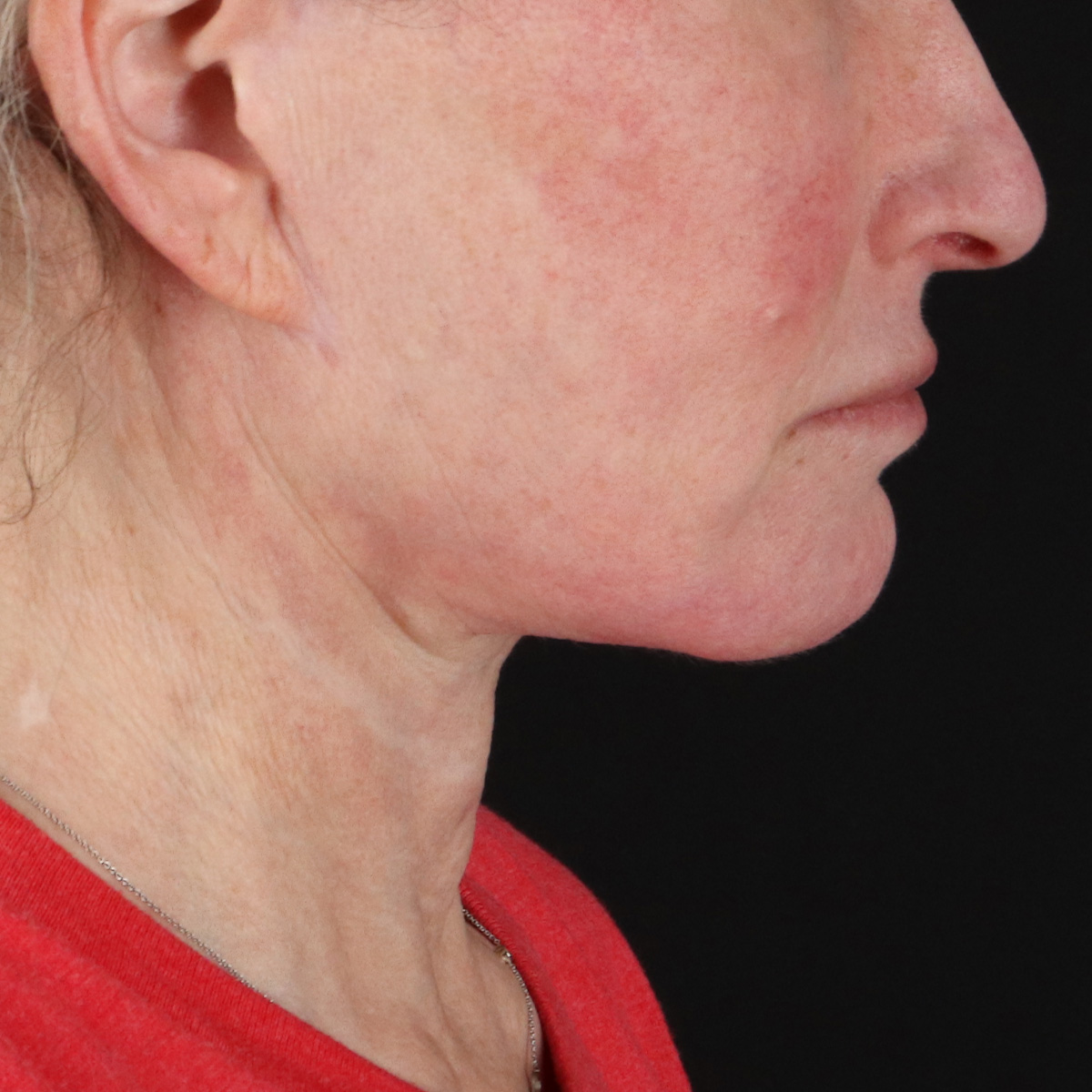 Facelift Before & After Patient #1866