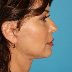 Neck Lift Before & After Patient #2699