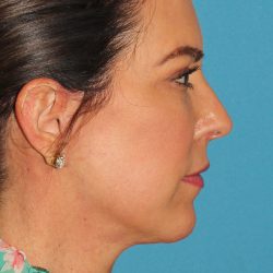 Chin Implant Before & After Patient #1659