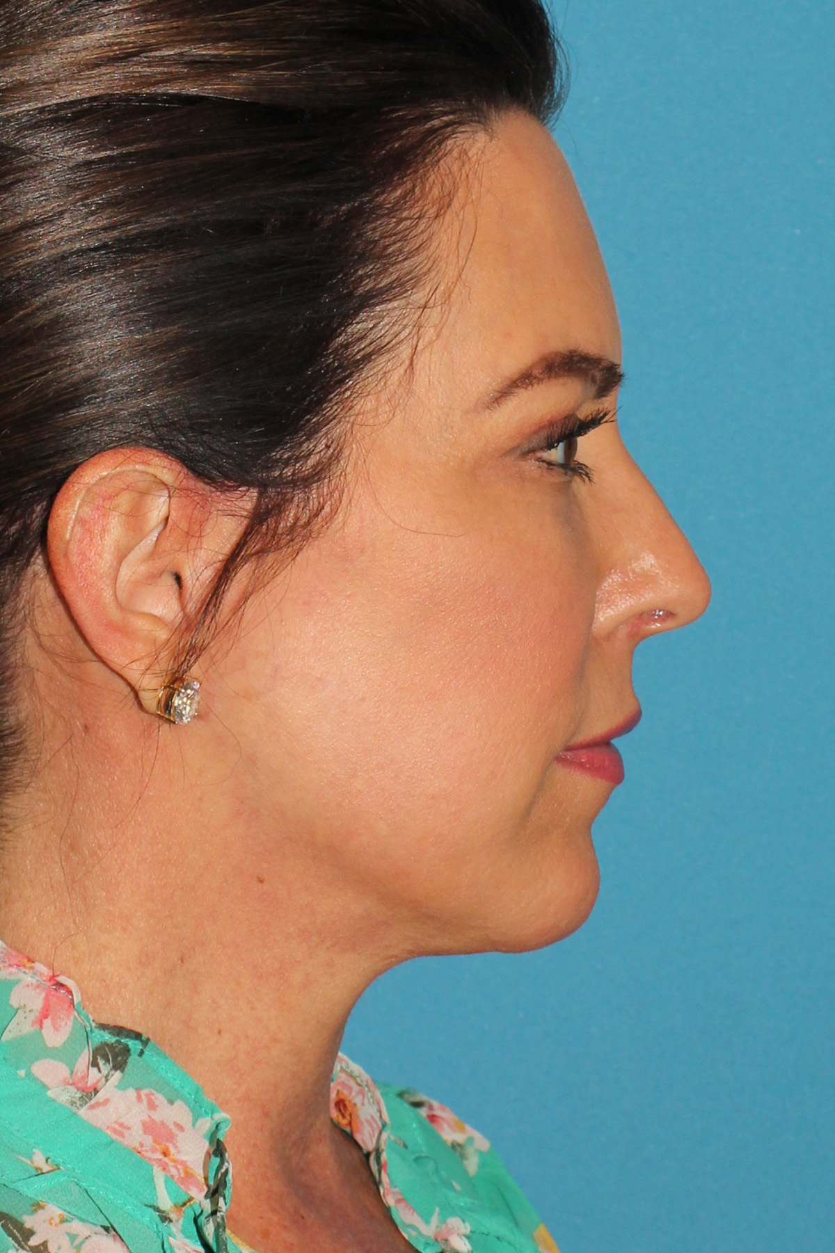 Chin Implant Before & After Patient #1659