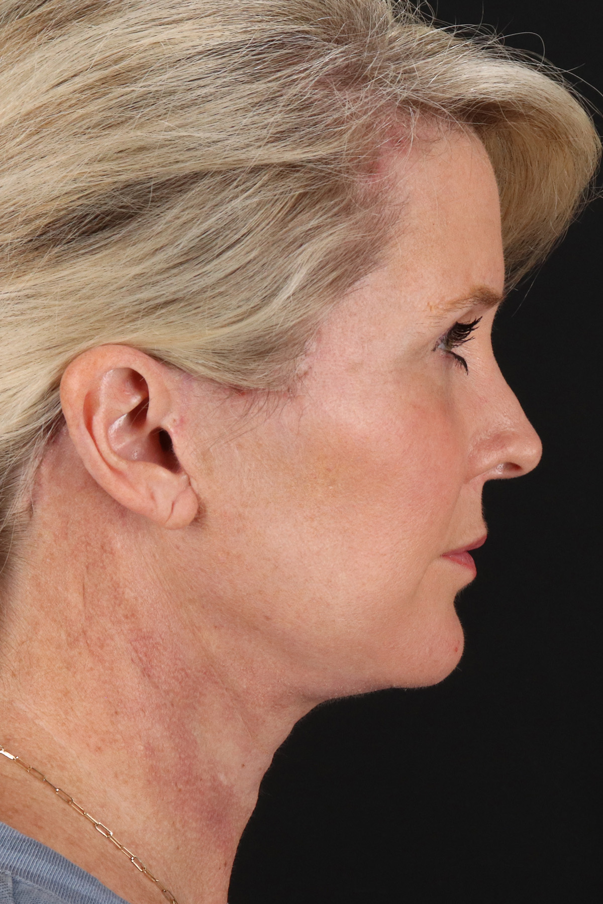 Neck Lift Before & After Patient #2582