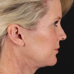 Facelift Before & After Patient #1877