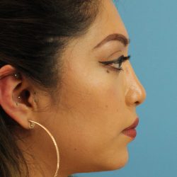 Chin Implant Before & After Patient #1670