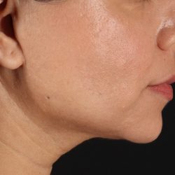 Facelift Before & After Patient #3555