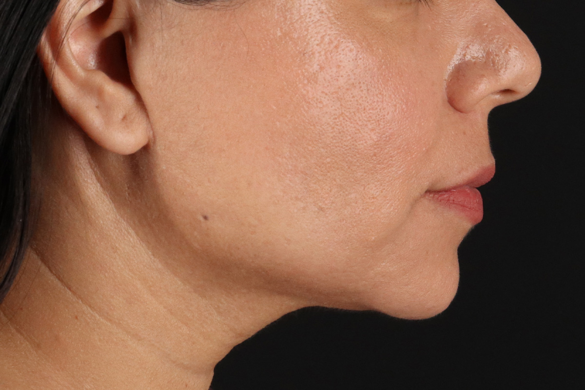 Facelift Before & After Patient #3555