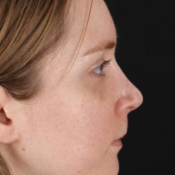 Rhinoplasty Before & After Patient #3280