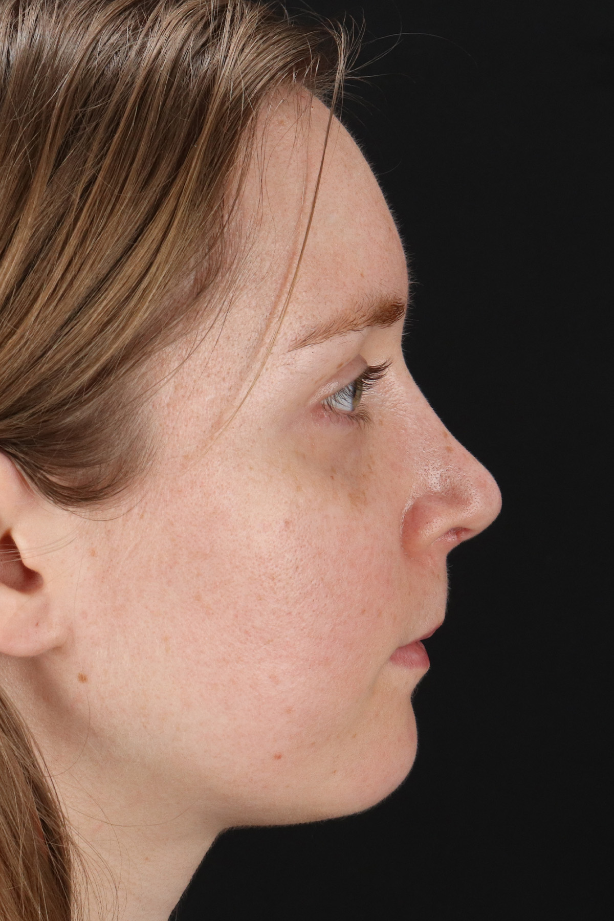 Rhinoplasty Before & After Patient #3280
