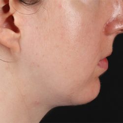Chin Implant Before & After Patient #1562