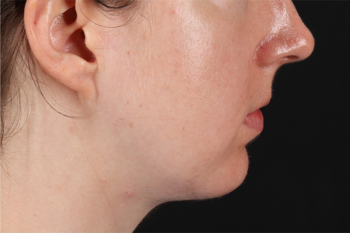 Chin Implant Before & After Patient #1562