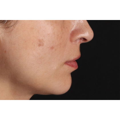 Lip Lift Before & After Patient #2166