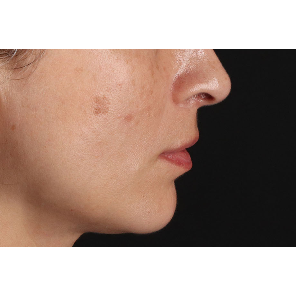 Lip Lift Before & After Patient #2166