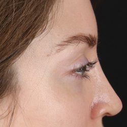 Browlift Before & After Patient #1319