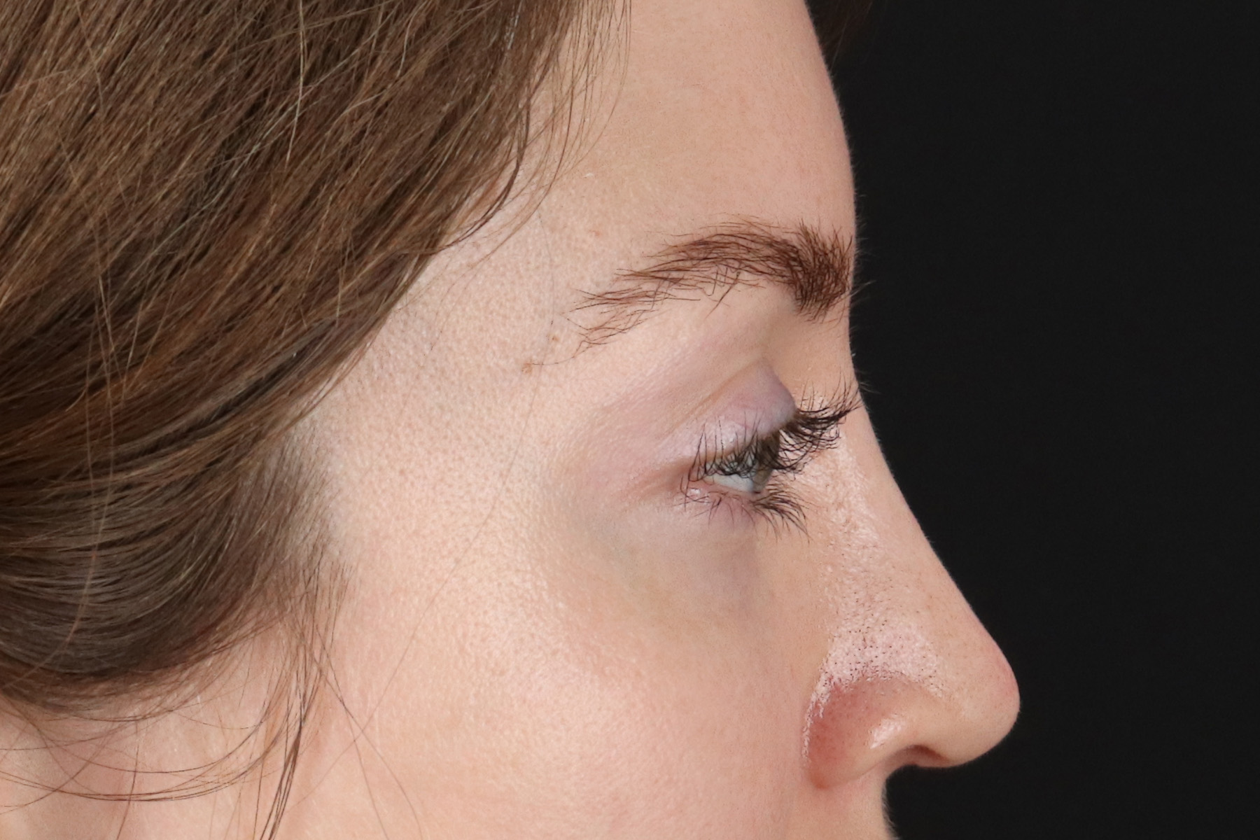 Browlift Before & After Patient #1319