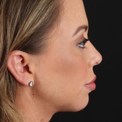 Chin Implant Before & After Patient #1518