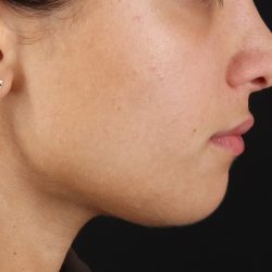 Chin Implant Before & After Patient #1573