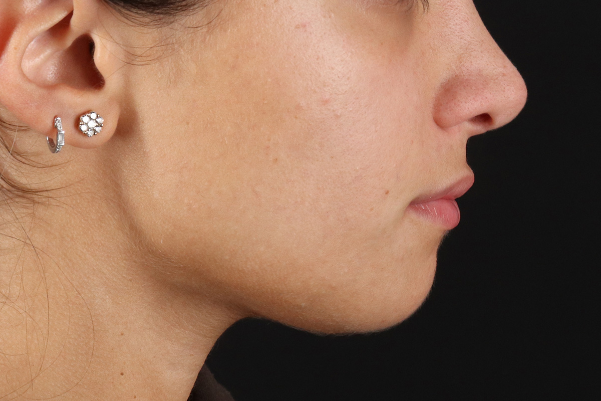 Chin Implant Before & After Patient #1573