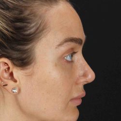 Browlift Before & After Patient #1297