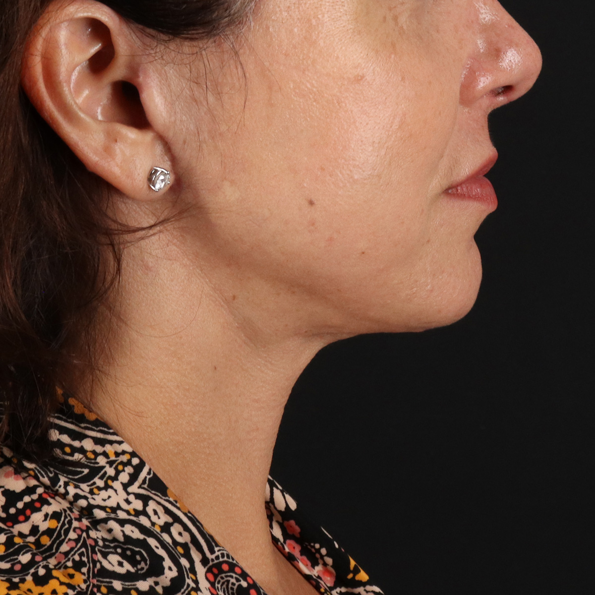 Neck Lift Before & After Patient #2472