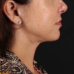 Facelift Before & After Patient #1809