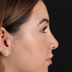 Rhinoplasty Before & After Patient #3247