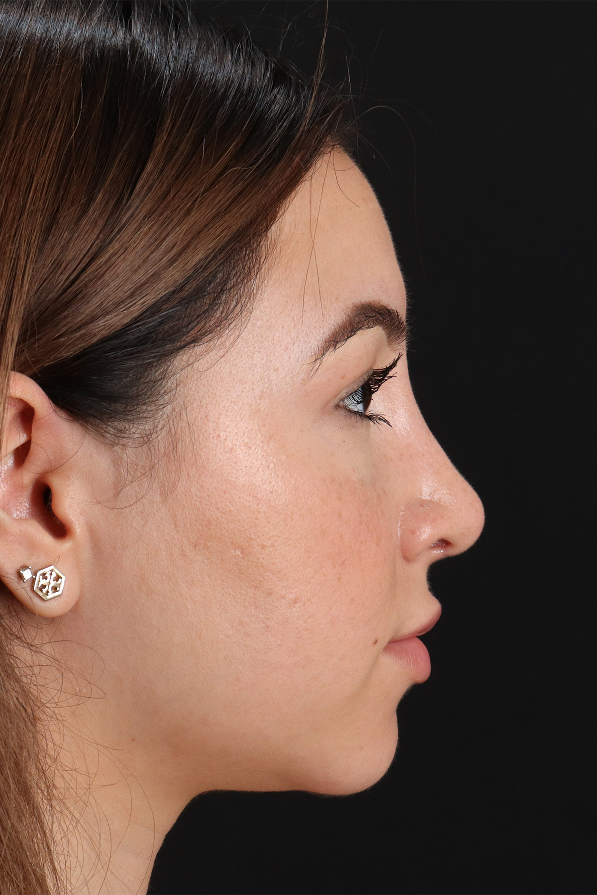 Rhinoplasty Before & After Patient #3247